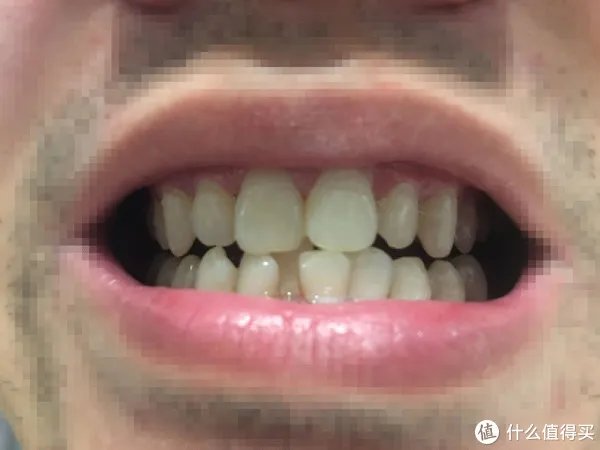 贝医生声波电动牙刷使用心得