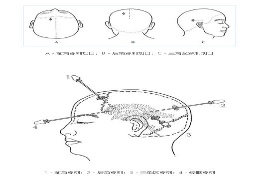 脑室外引流穿刺部位图片