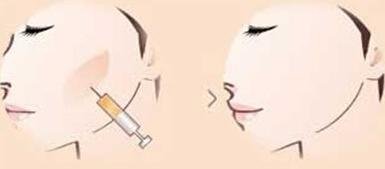 打了4支玻尿酸填充脸颊好吗