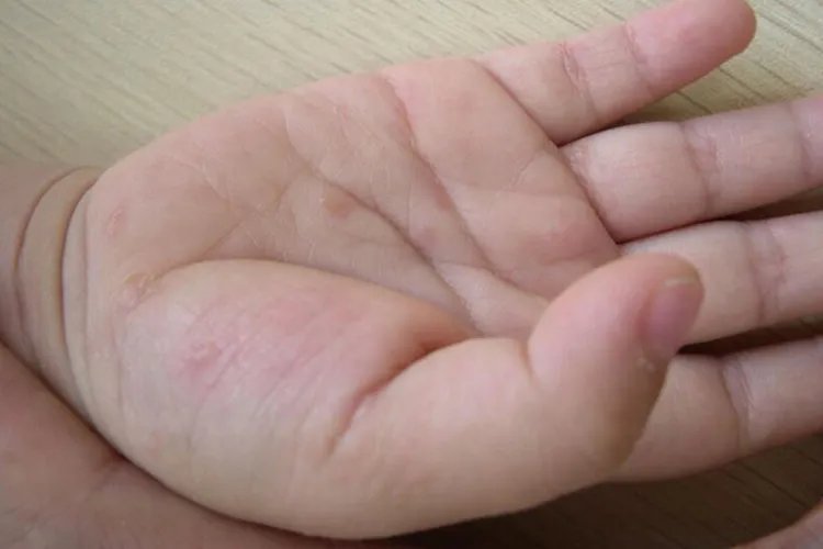 宝宝疥疮初期图片