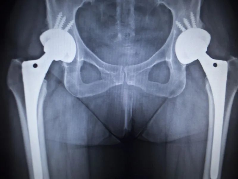 骨关节活素是什么