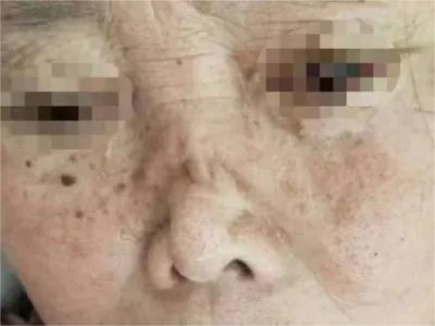 韦氏肉芽肿病变形图片