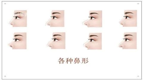 什么是耳软骨隆鼻