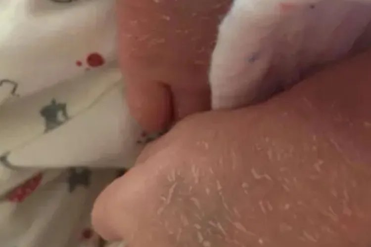 小婴儿轻微鱼鳞病图片