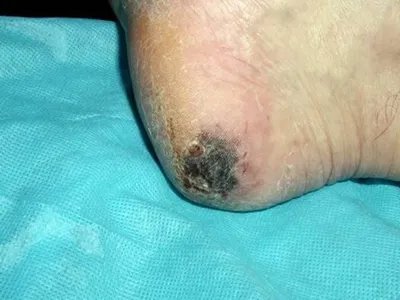 恶性雀斑样痣黑斑图片