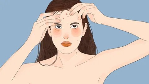 治疗痤疮色斑的方法