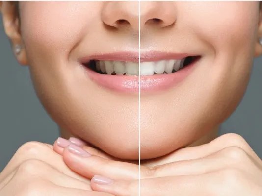 美白的护理措施