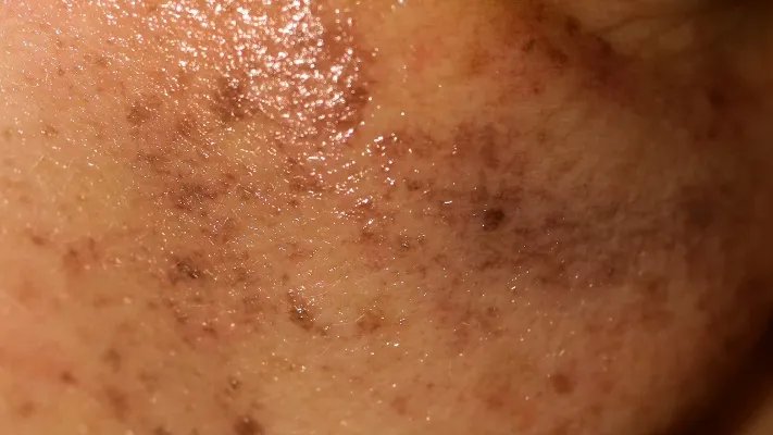 为什么长老年斑