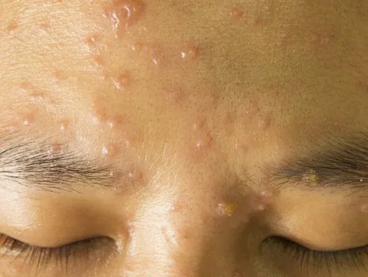 怎样才能不长青春痘