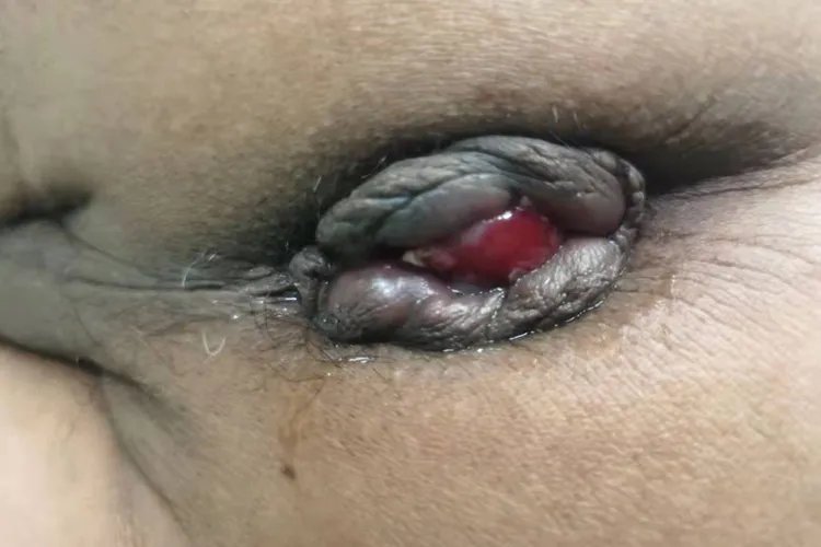 什么是痔疮图片