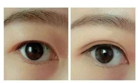 割双眼皮比较好