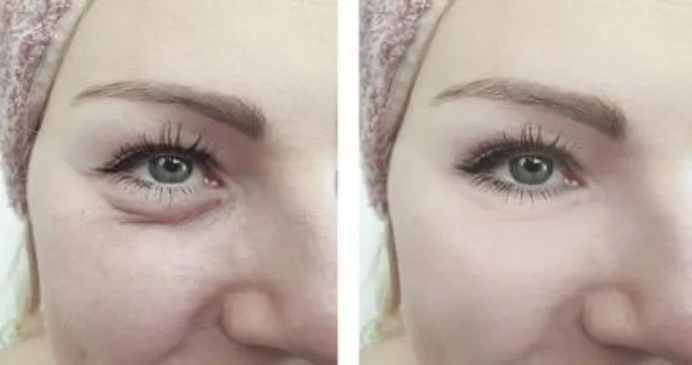 做去眼袋手术后能吃鸡蛋吗 做去眼袋手术后饮食注意三点