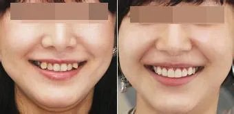 虎牙矫正的价格