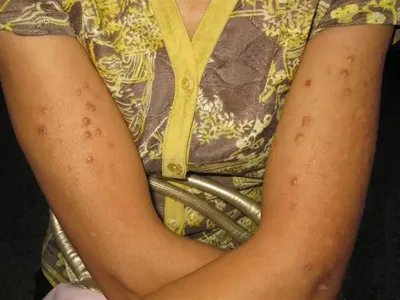 单纯性痒疹胳膊丘疹图片