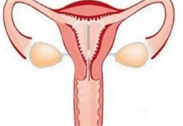 刚刚做完人流要注意什么？不能吃什么？