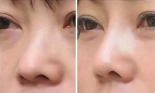 做鼻尖缩小多少钱
