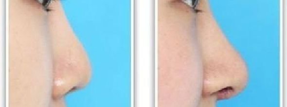 玻尿酸隆鼻多少钱一针啊