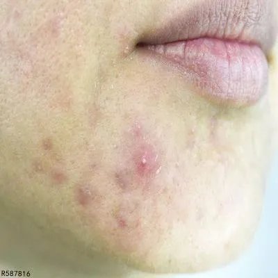 面部痤疮如何治疗