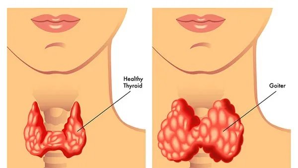 甲状腺癌术后饮食