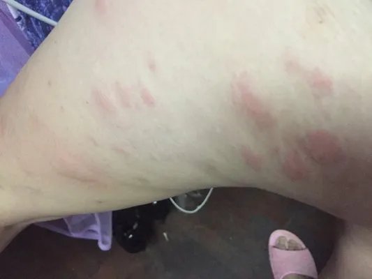 吃芒果过敏有什么症状?