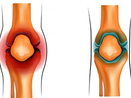 滑膜炎是什么意思