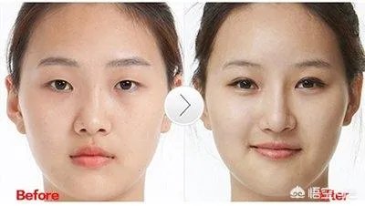 眼部整形手术的价钱是多少?