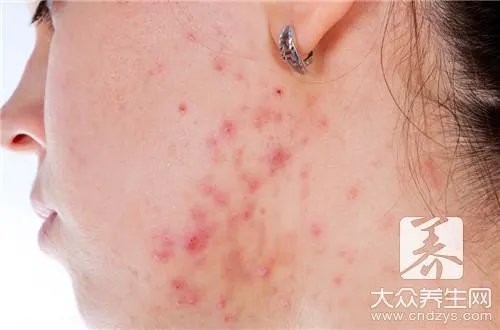 姜黄消痤搽剂去痘印的效果怎么样?