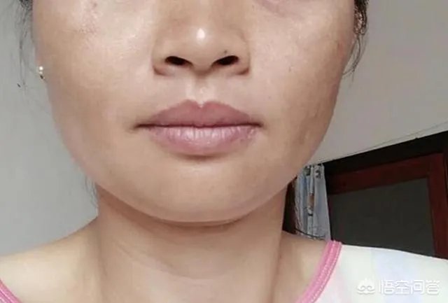 有了黄褐斑，该如何淡化不反弹？