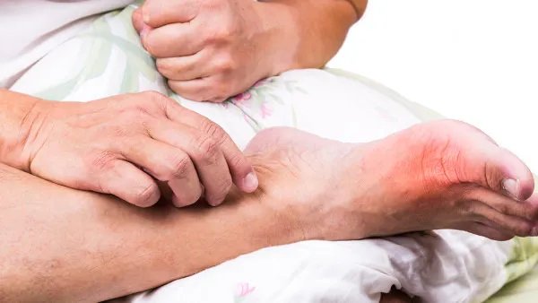 脚气灰指甲怎么根治