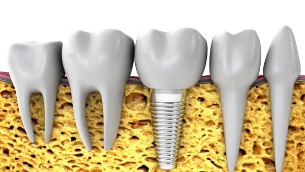 植一颗牙需要多少钱？
