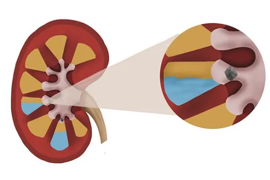 肾结石是怎么引起的