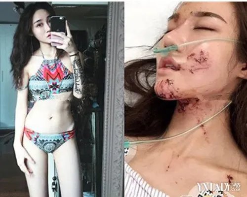 知名网红被毁容引发热议前后对比照片网友直呼实在太可惜