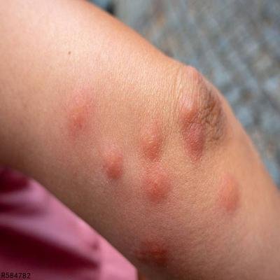 治疗皮肤过敏的药物有哪些 治疗皮肤过敏三种药常用