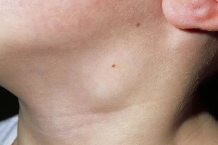 儿童淋巴结肿大图片