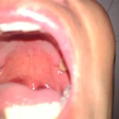 甲状腺结节怎么治疗比较好