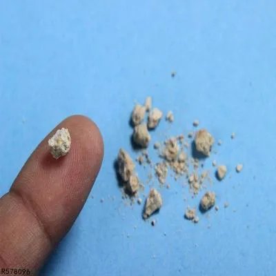 肾结石的饮食注意事项有哪些