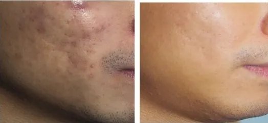 凹陷性疤痕怎样消除