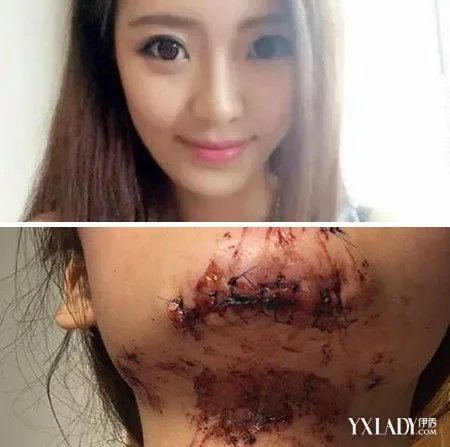 知名网红被毁容引发热议前后对比照片网友直呼实在太可惜