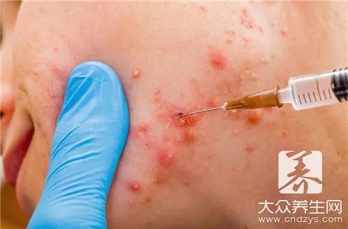 姜黄消痤搽剂去痘印的效果怎么样?