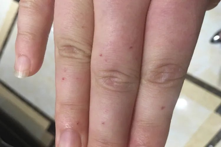 肝癌早期图片高清图片大全