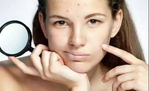 光子嫩肤祛痘后注意什么