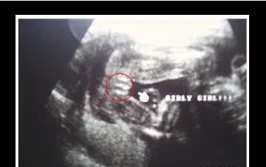 男胎儿小鸡b超显示图：超准的b超图看生男生女