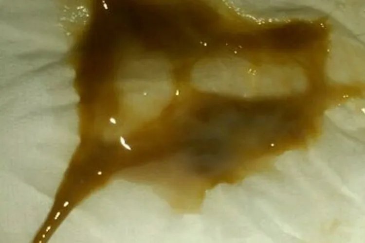 怀孕初期分泌物是什么样子