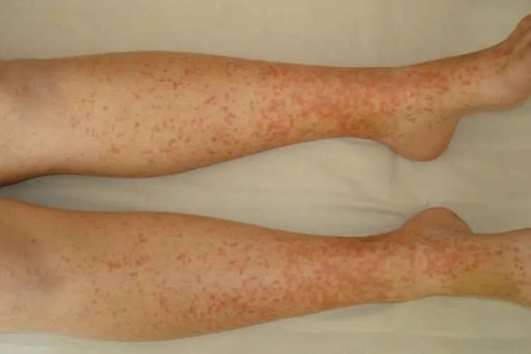 过敏性紫癜病是什么原因引起的图片