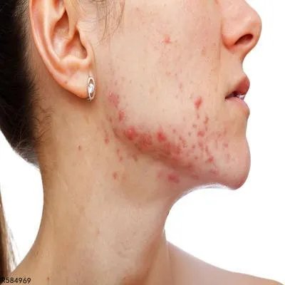 治疗闭合性痤疮的方法有哪些 治疗闭合性的5个常见方法盘点