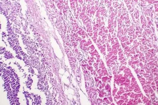 感染了幽门螺旋杆菌怎么办 感染了幽门螺旋杆菌需注意三点