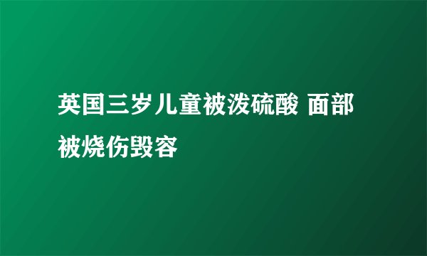 英国三岁儿童被泼硫酸 面部被烧伤毁容