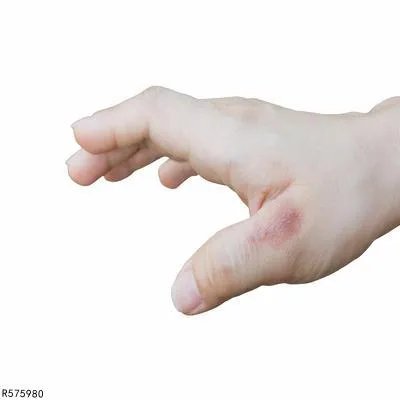 烫伤如何处理好的更快  揭秘烫伤的正确处理方法