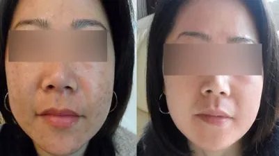 北京激光美容多少钱