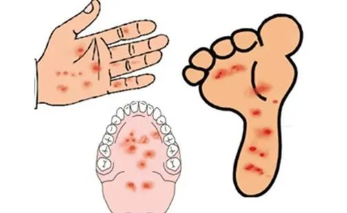 小儿手足口病最早期图片